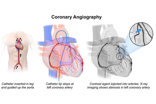 What You Need to Know About Coronary Angiography